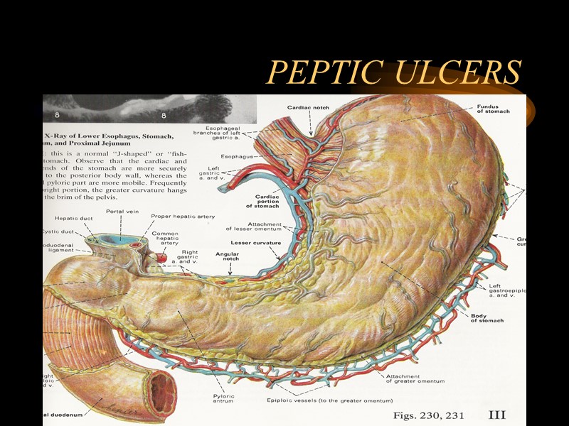 PEPTIC ULCERS